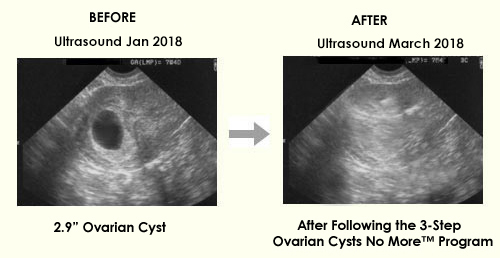 carol foster ovarian cyst miracle